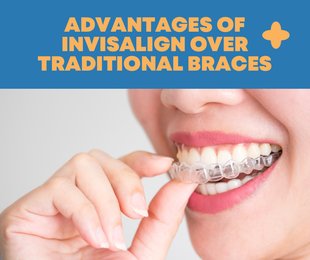 Discover the Advantages of Invisalign over Traditional Braces